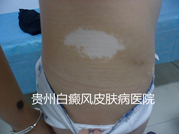 Ƥ�����׾��ǻ��а�������