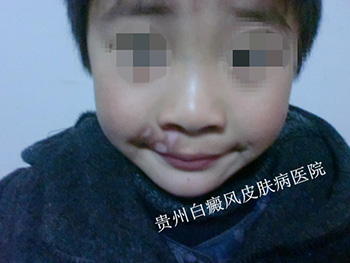 面部白癜风的危害有哪些