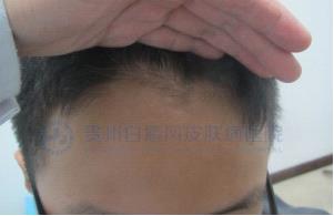 治好白癜风,做回快乐的“小王子”