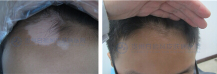 治好白癜风,做回快乐的“小王子”