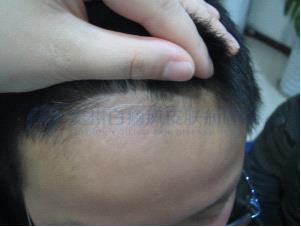 治好白癜风,做回快乐的“小王子”