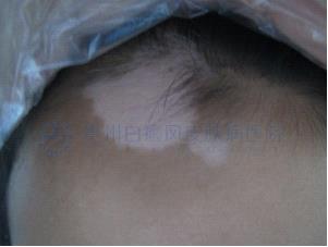 治好白癜风,做回快乐的“小王子”