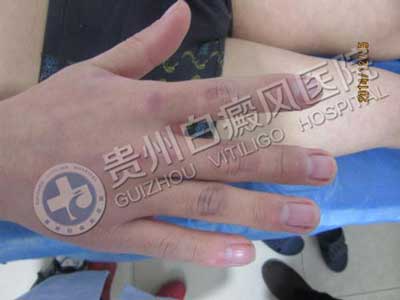 【康复案例之最】最难治疗肢端型白斑:因为这样治疗,3年5次复发