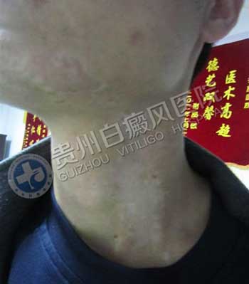 【康复案例之最】成年康复时间最短:中年司机用三年总结出答案,31天治好白癜风