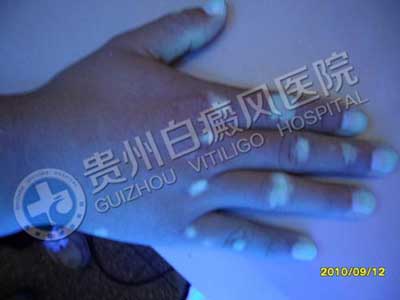 【康复案例之最】最难治疗肢端型白斑:因为这样治疗,3年5次复发