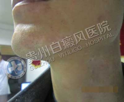 【康复案例之最】成年康复时间最短:中年司机用三年总结出答案,31天治好白癜风