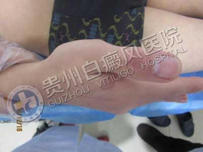 【康复案例之最】最难治疗肢端型白斑:因为这样治疗,3年5次复发