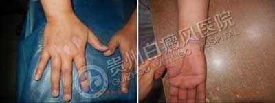 【康复案例之最】最难治疗肢端型白斑:因为这样治疗,3年5次复发