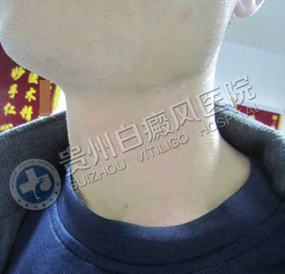 【康复案例之最】成年康复时间最短:中年司机用三年总结出答案,31天治好白癜风