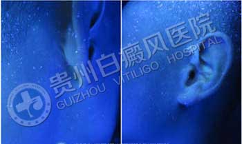 【康复案例之最】临床治疗最难:祛白耳聋二选一,软组织白癜风治疗难在何处?
