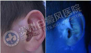 【康复案例之最】临床治疗最难:祛白耳聋二选一,软组织白癜风治疗难在何处?