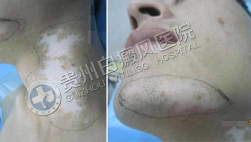 【康复案例之最】成年康复时间最短:中年司机用三年总结出答案,31天治好白癜风