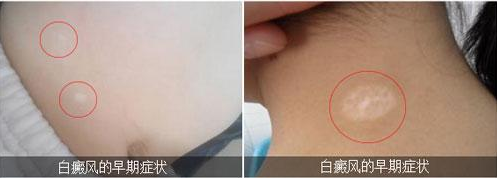 白癜风是怎么引起的?