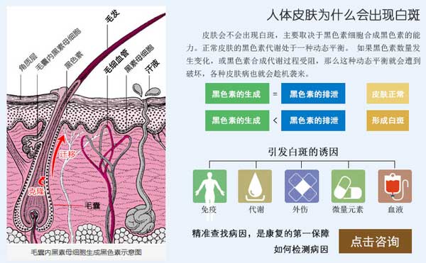 白癜风是怎么引起的?