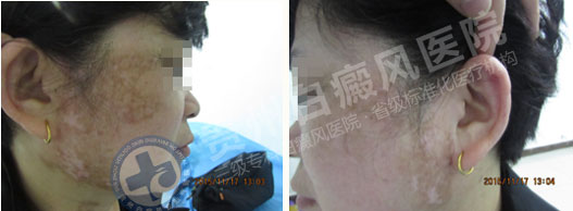 不明白斑让我遭到嫌弃,贵州白癜风医院让我看到了希望