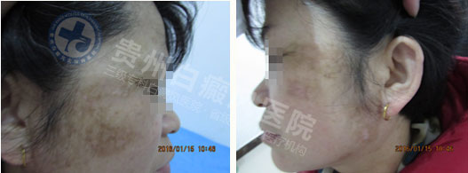 不明白斑让我遭到嫌弃,贵州白癜风医院让我看到了希望