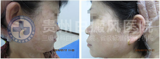 不明白斑让我遭到嫌弃,贵州白癜风医院让我看到了希望