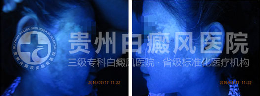 不明白斑让我遭到嫌弃,贵州白癜风医院让我看到了希望
