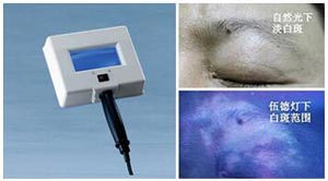 白癜风能治好吗?