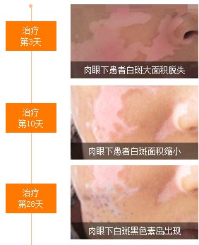 白癜风能治好吗?