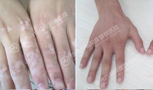 白癜风能治好吗?