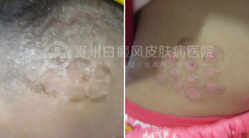 精心治疗助人康复,用心服务赢得赞扬